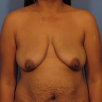 Breast Lift - Case 338 - Before