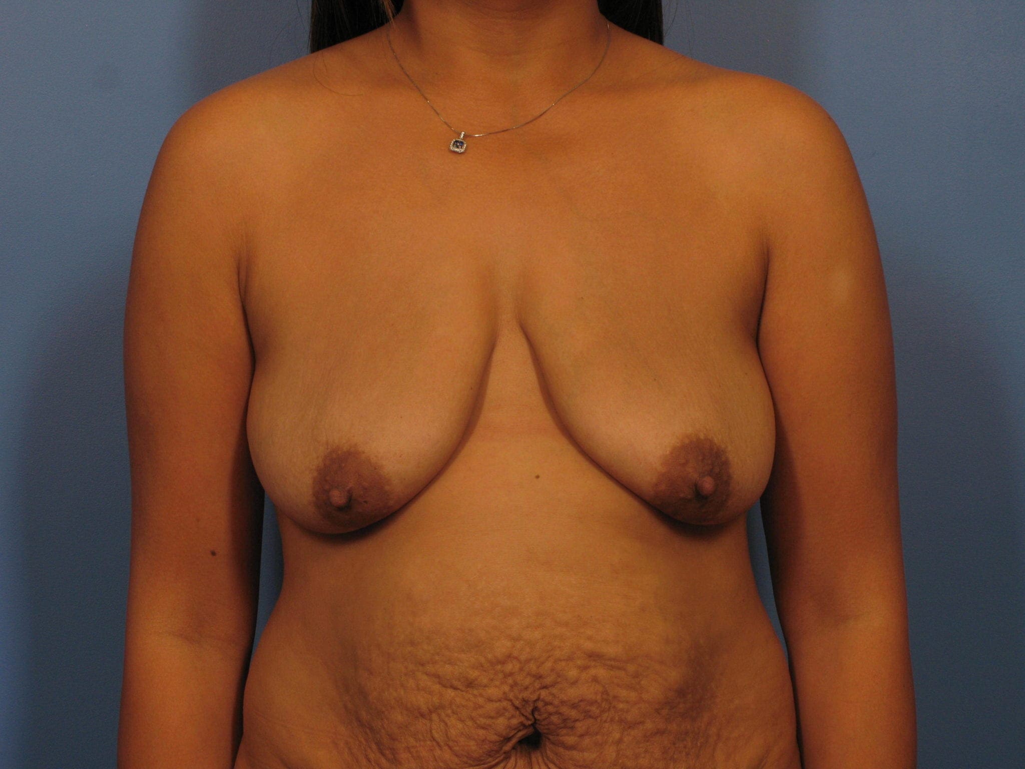 Breast Lift Patient Photo - Case 338 - before view-0
