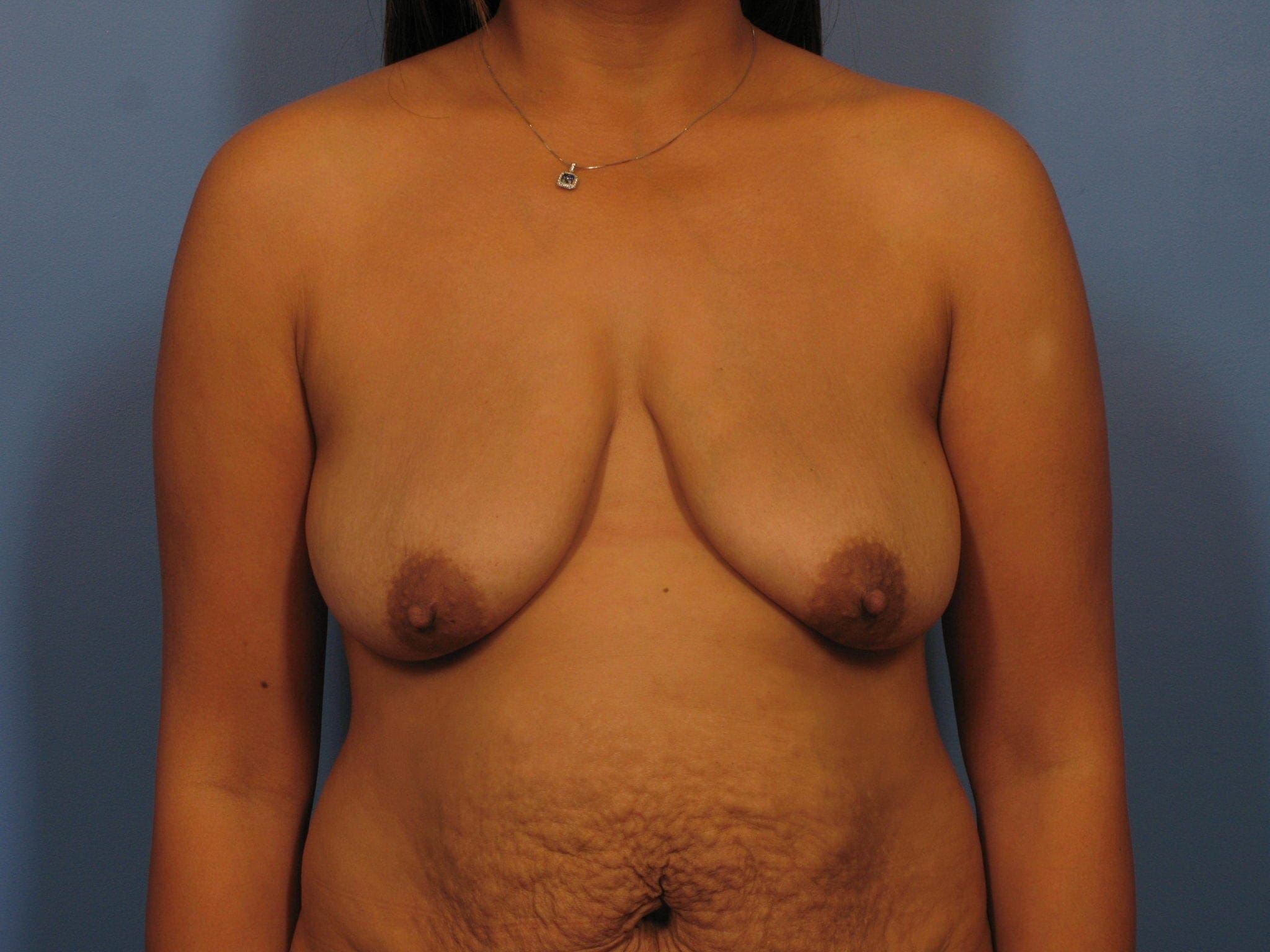 Breast Lift Patient Photo - Case 338 - before view-