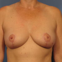 Breast Lift - Case 340 - After