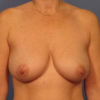 Breast Lift - Case 340 - Before