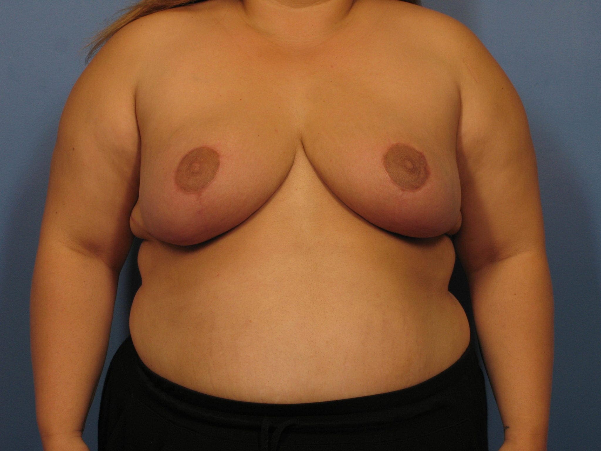 Breast Reduction - Case 343 - After