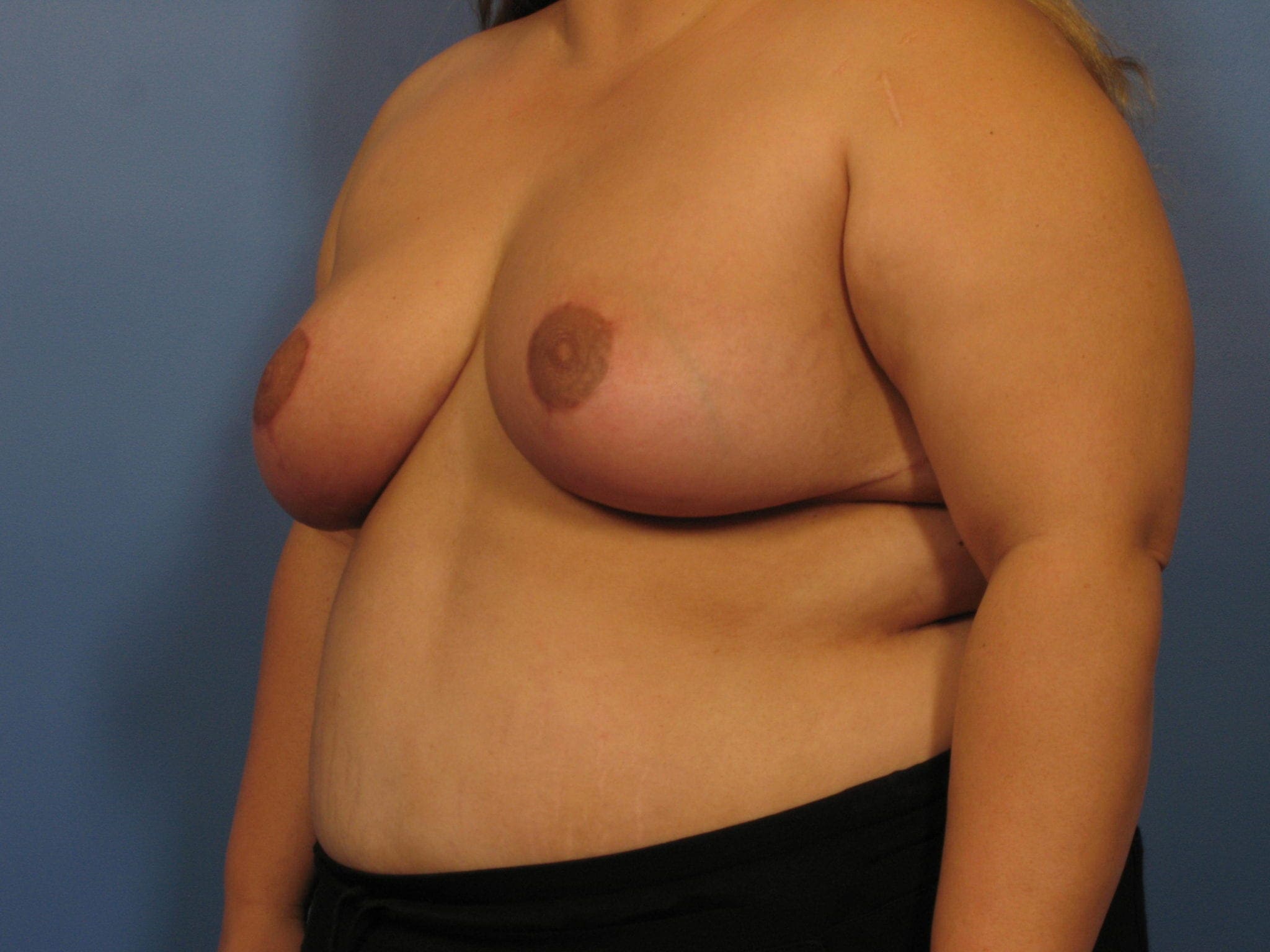 Breast Reduction Patient Photo - Case 343 - after view-1