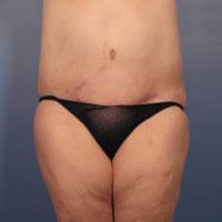 After Major Weight Loss - Case 352 - After