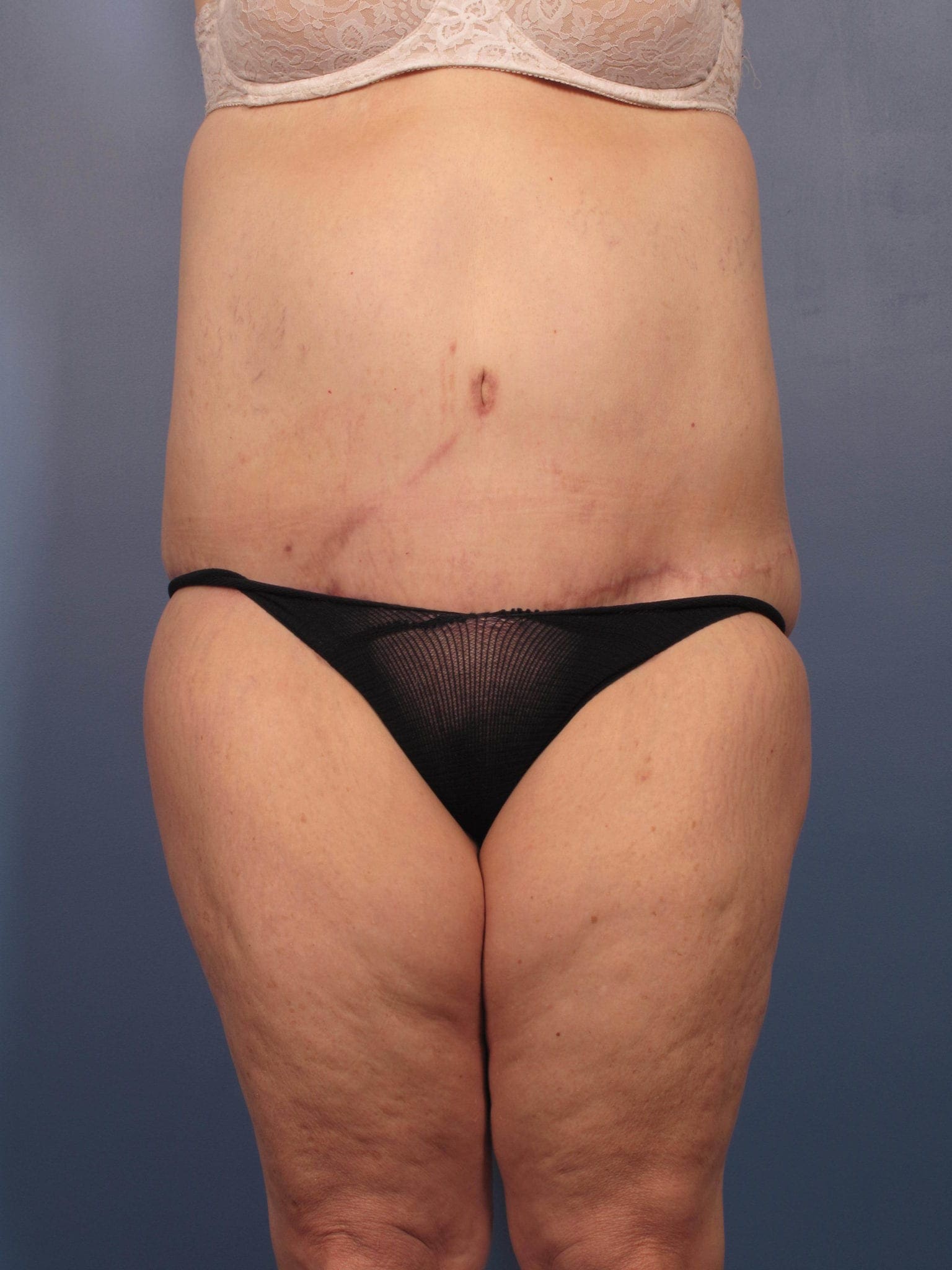 After Major Weight Loss Patient Photo - Case 352 - after view