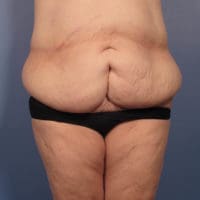 After Major Weight Loss - Case 352 - Before
