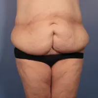 After Major Weight Loss - Case 352 - Before