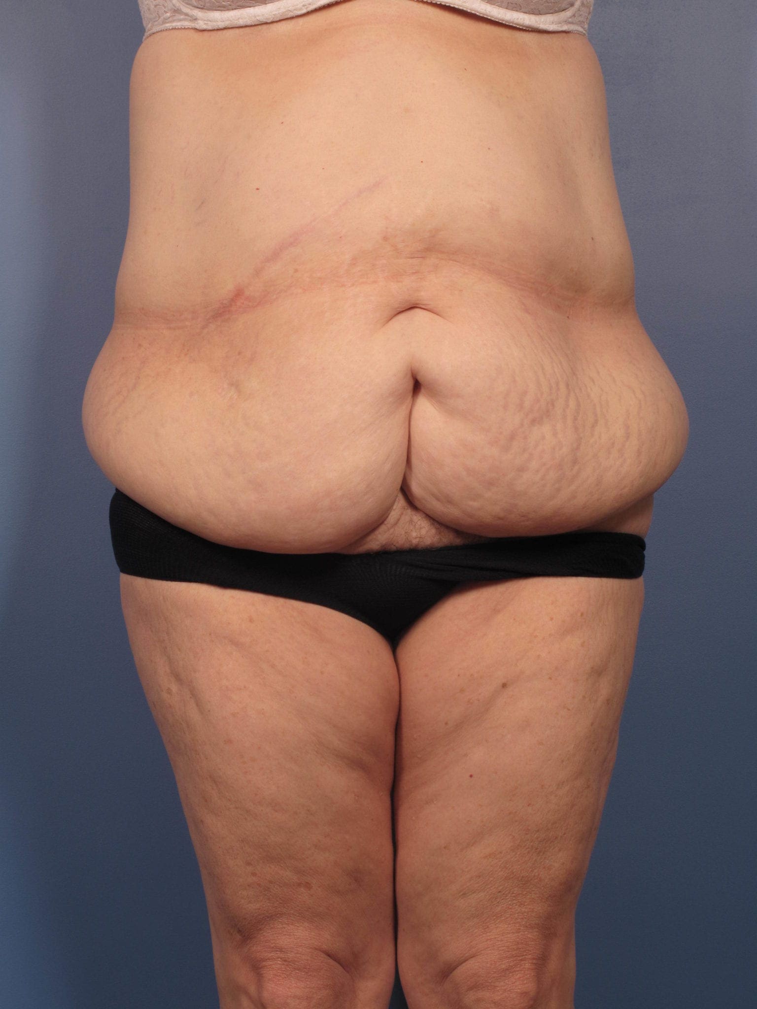 After Major Weight Loss Patient Photo - Case 352 - before view-