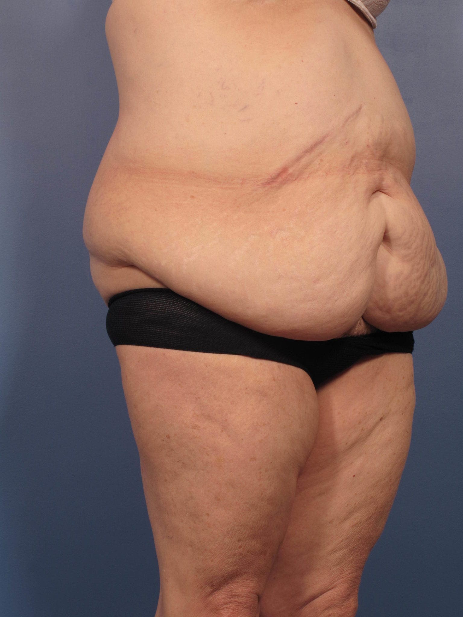 After Major Weight Loss Patient Photo - Case 352 - before view-1