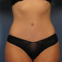 Tummy Tuck - Case 353 - After