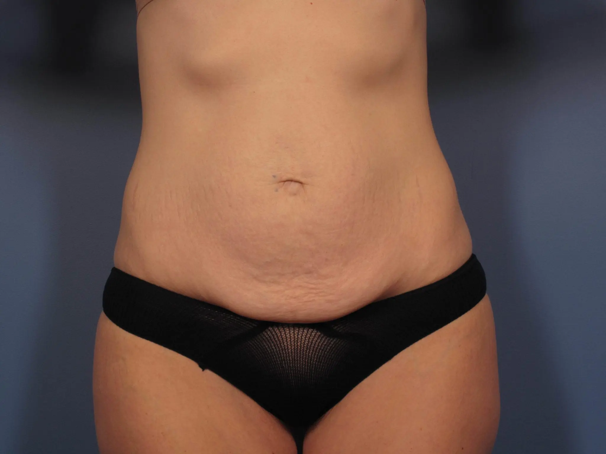 Tummy Tuck Patient Photo - Case 353 - before view-