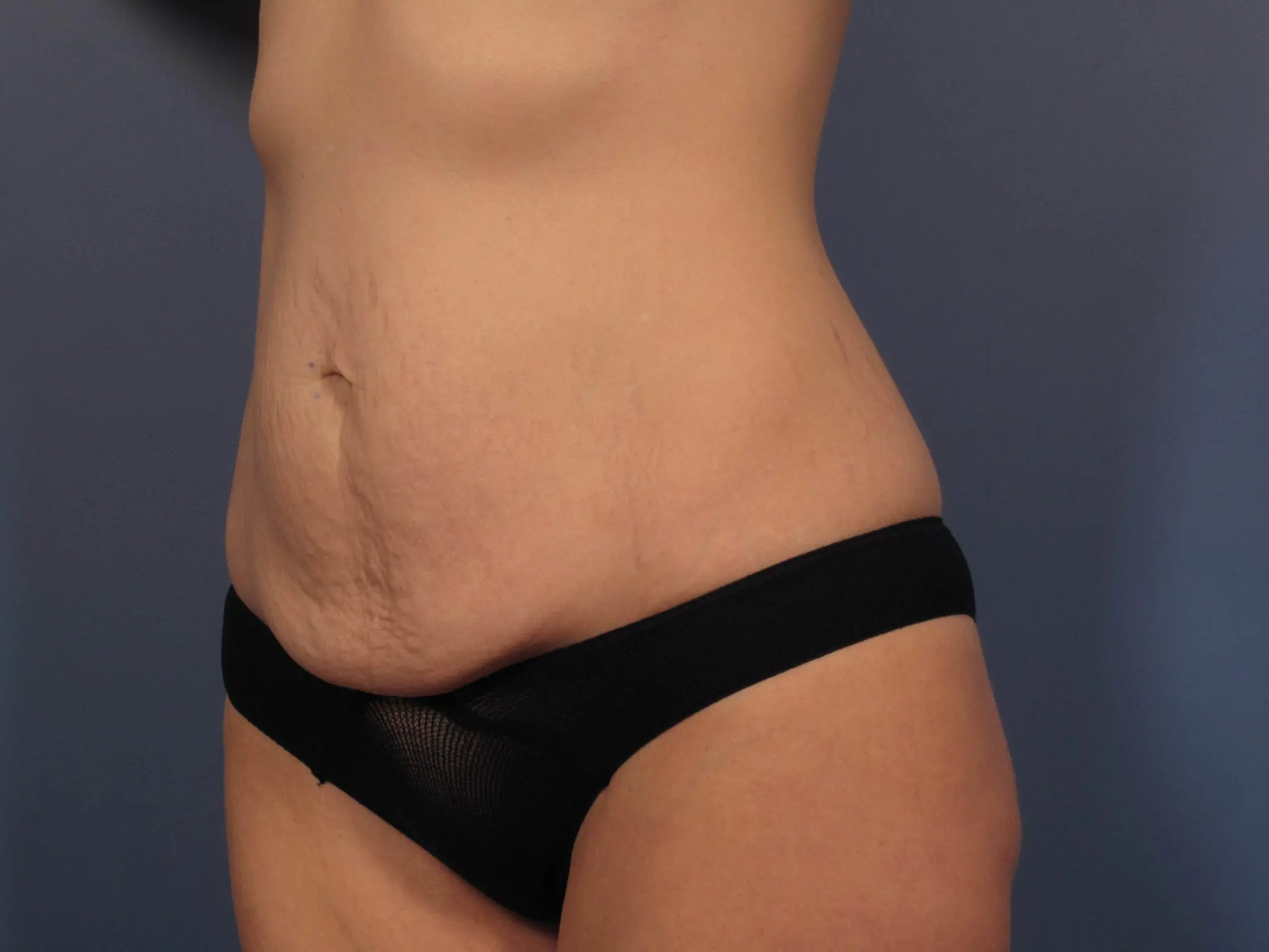 Tummy Tuck Patient Photo - Case 353 - before view-1