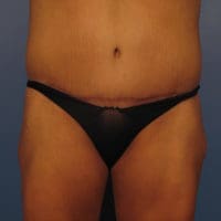 Tummy Tuck Revision - Case 354 - After