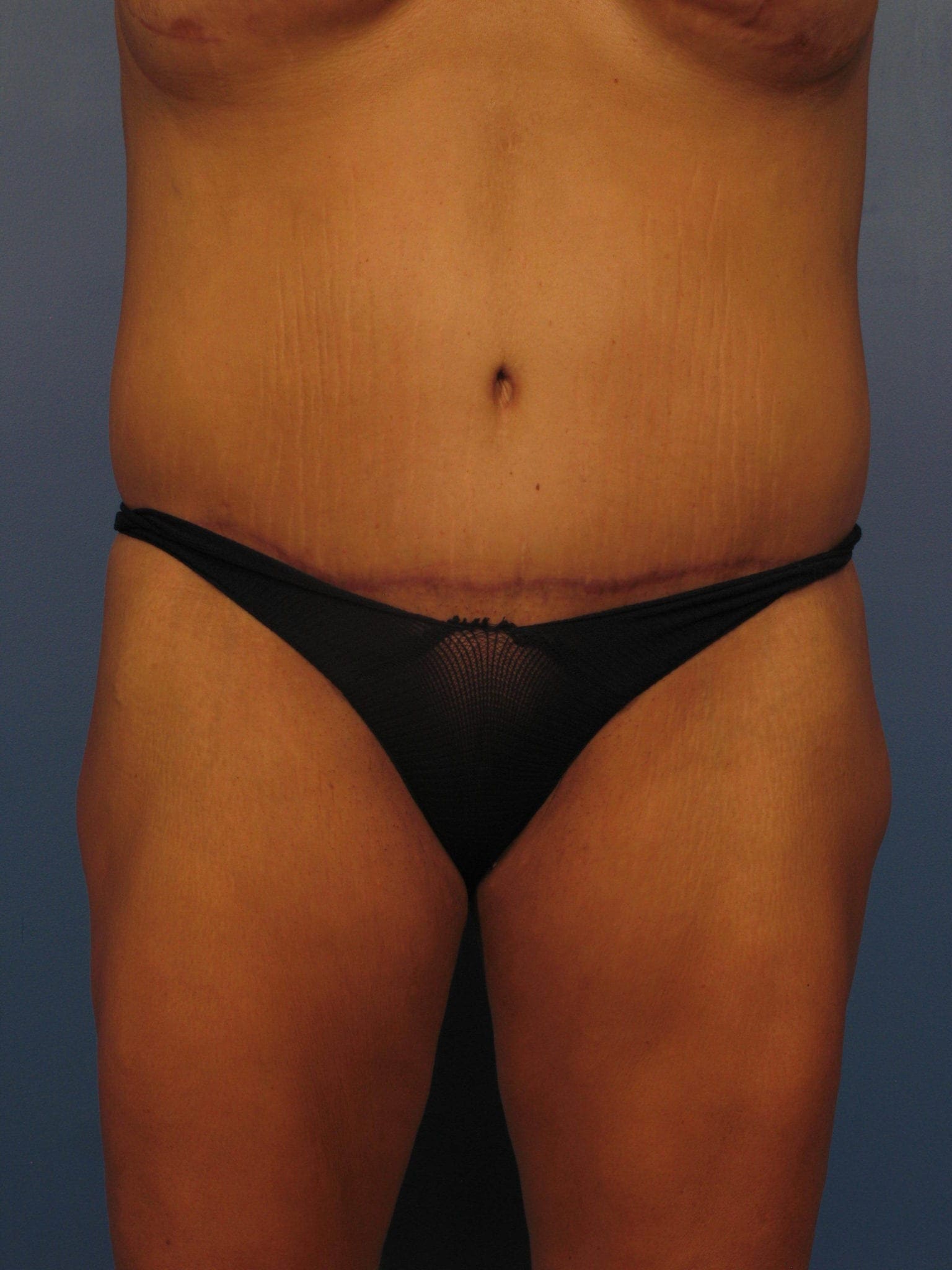 Tummy Tuck Revision Patient Photo - Case 354 - after view-0