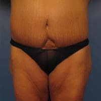 Tummy Tuck Revision - Case 354 - Before