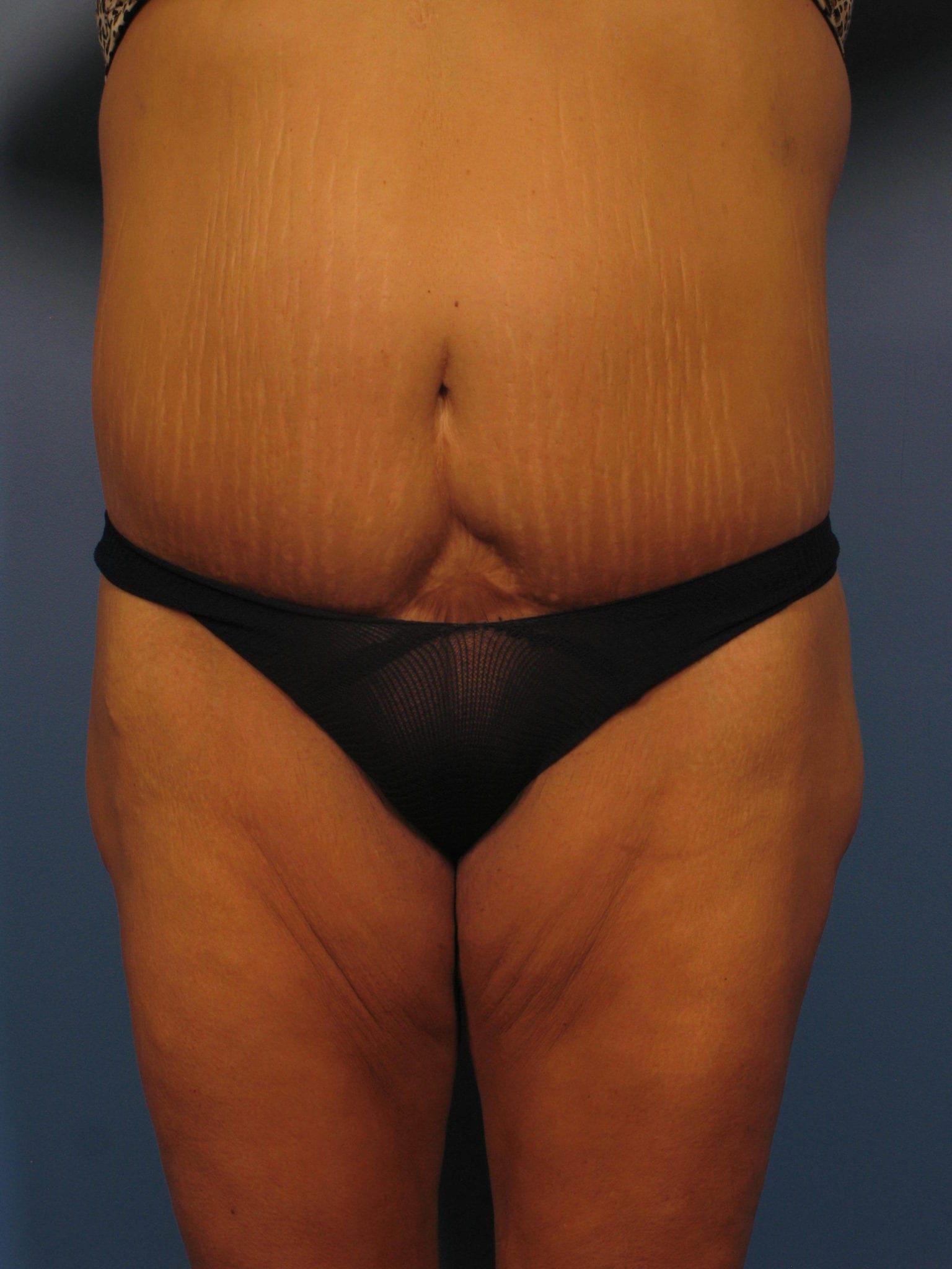 Tummy Tuck Revision Patient Photo - Case 354 - before view-