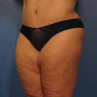 Tummy Tuck - Case 355 - After
