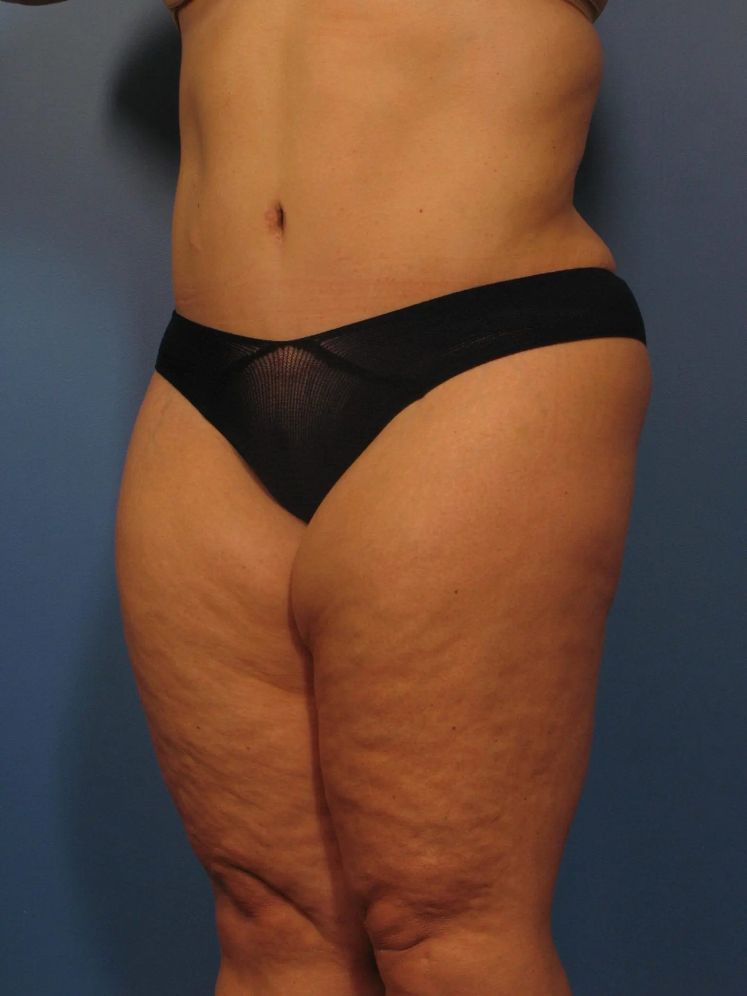 After Major Weight Loss Patient Photo - Case 355 - after view