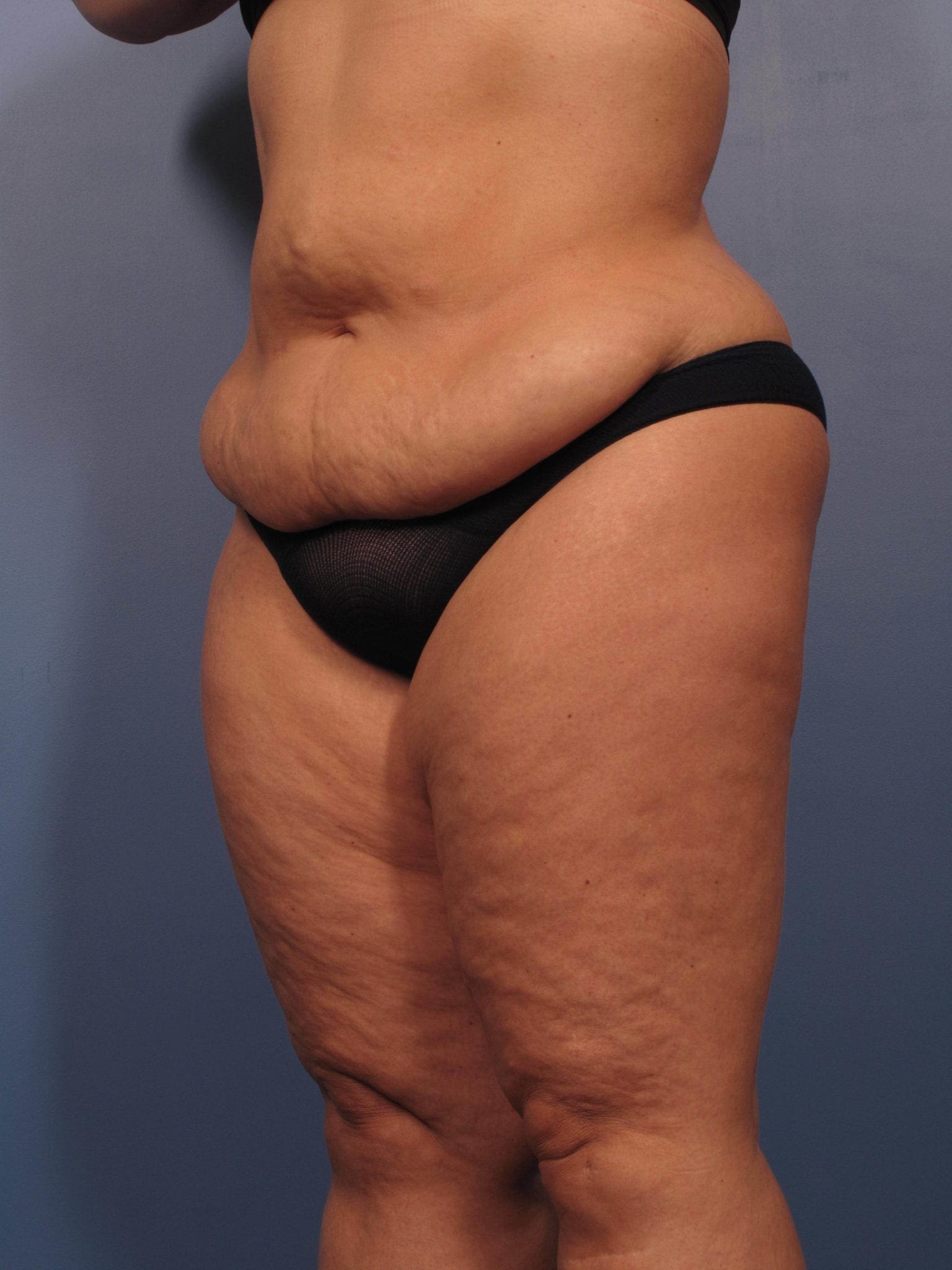 After Major Weight Loss Patient Photo - Case 355 - before view-0