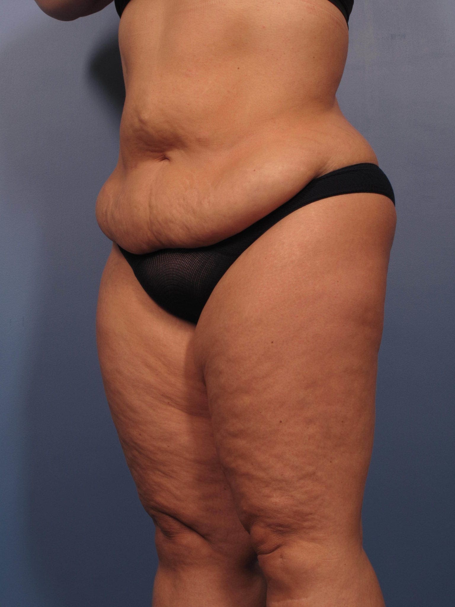 After Major Weight Loss Patient Photo - Case 355 - before view-