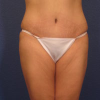 Tummy Tuck - Case 358 - After
