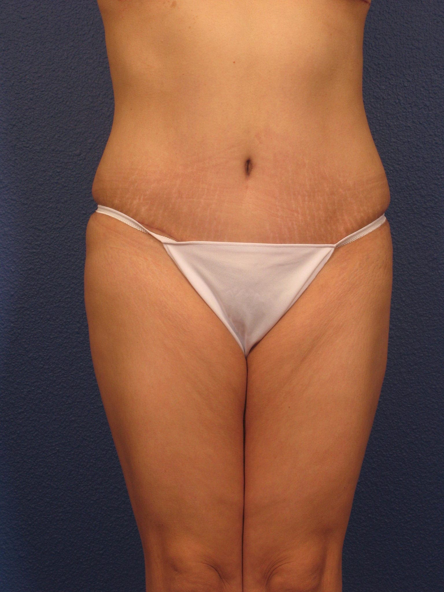 Tummy Tuck - Case 358 - After