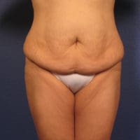 Tummy Tuck - Case 358 - Before