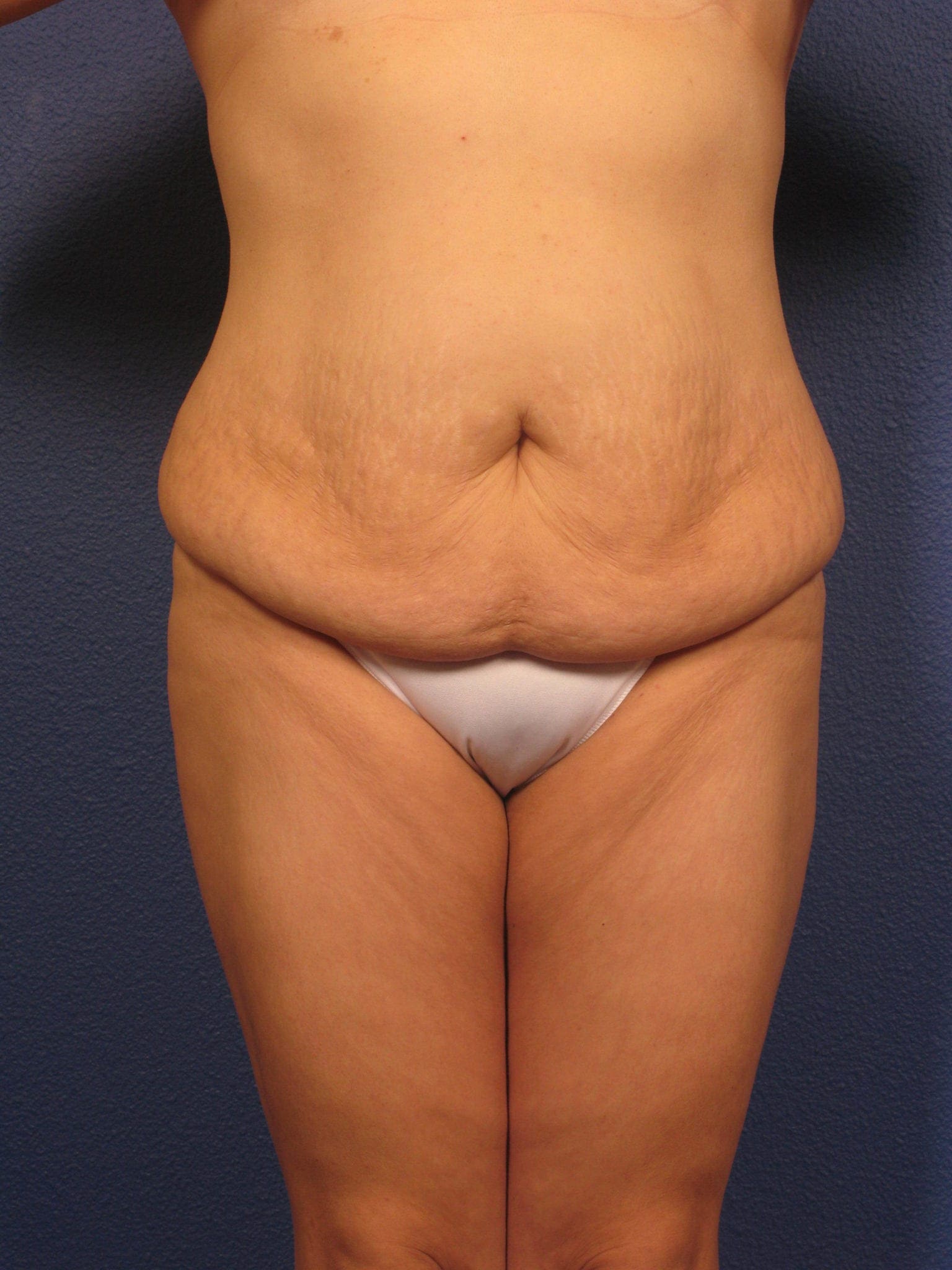 Tummy Tuck Patient Photo - Case 358 - before view-