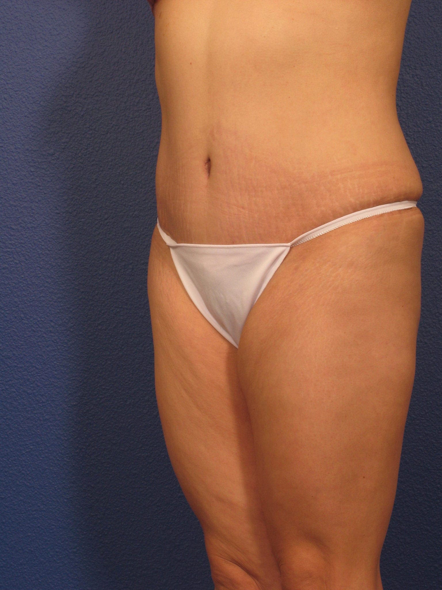 Tummy Tuck Patient Photo - Case 358 - after view-1