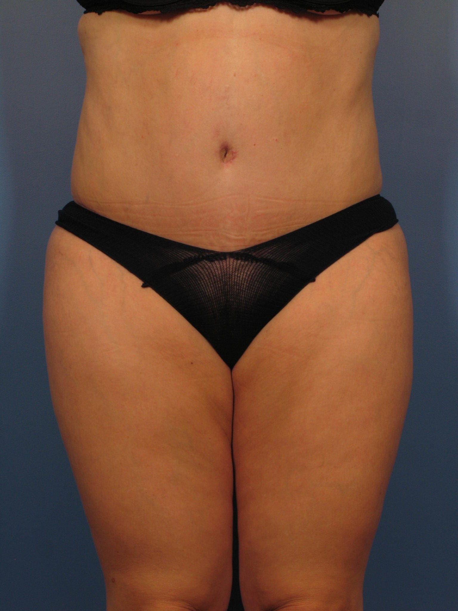 Tummy Tuck Patient Photo - Case 359 - after view