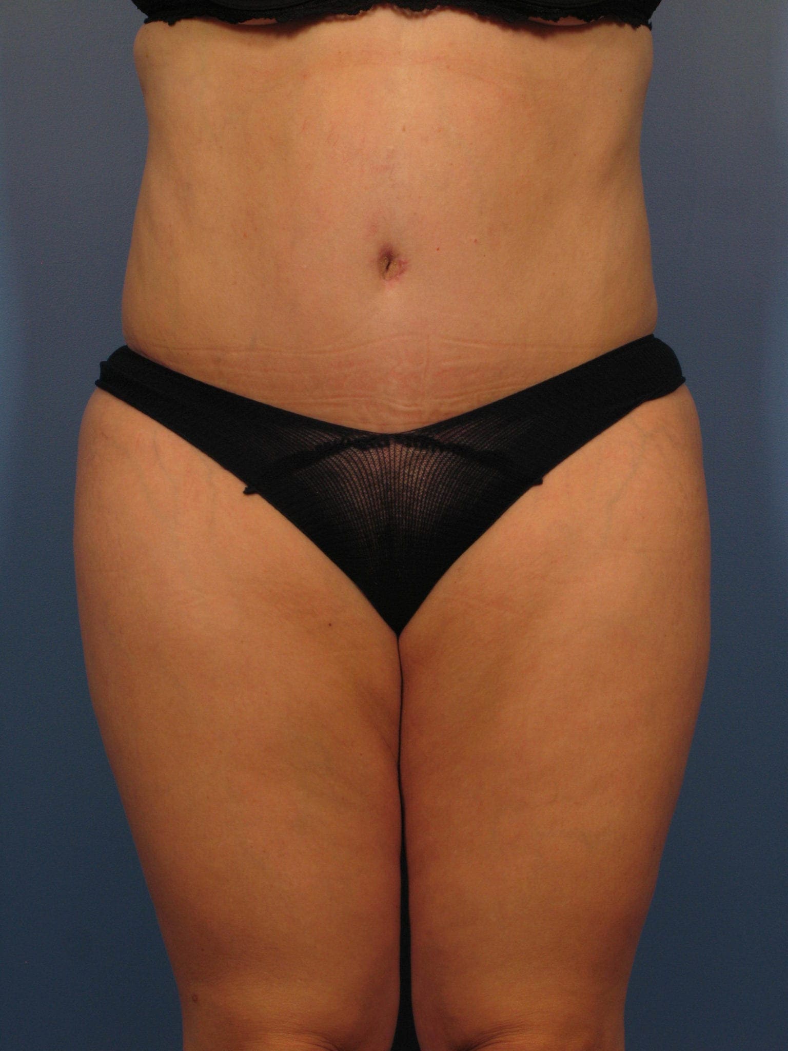 Liposuction Patient Photo - Case 359 - after view