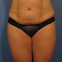 Liposuction - Case 359 - Before