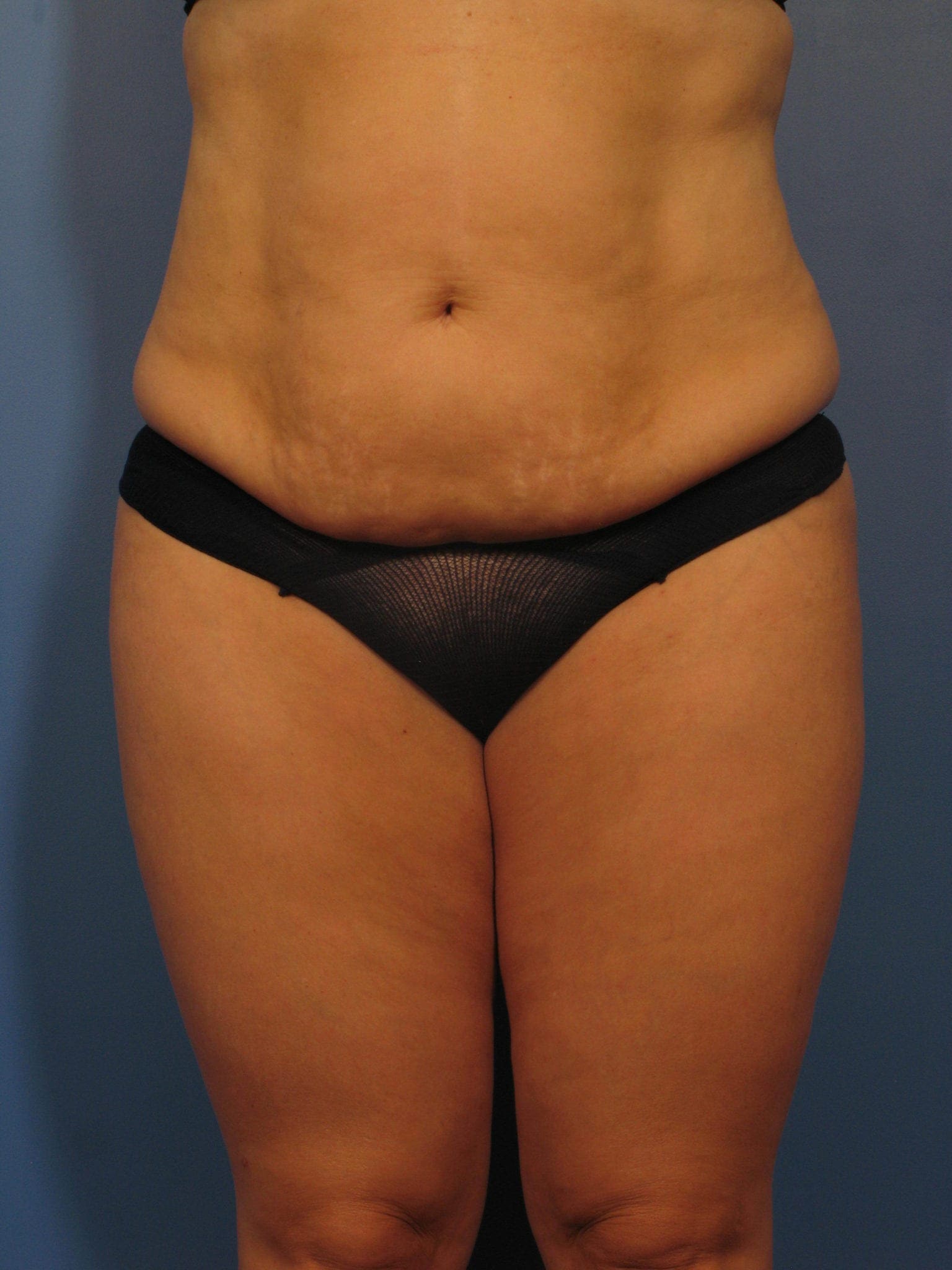 Liposuction - Case 359 - Before