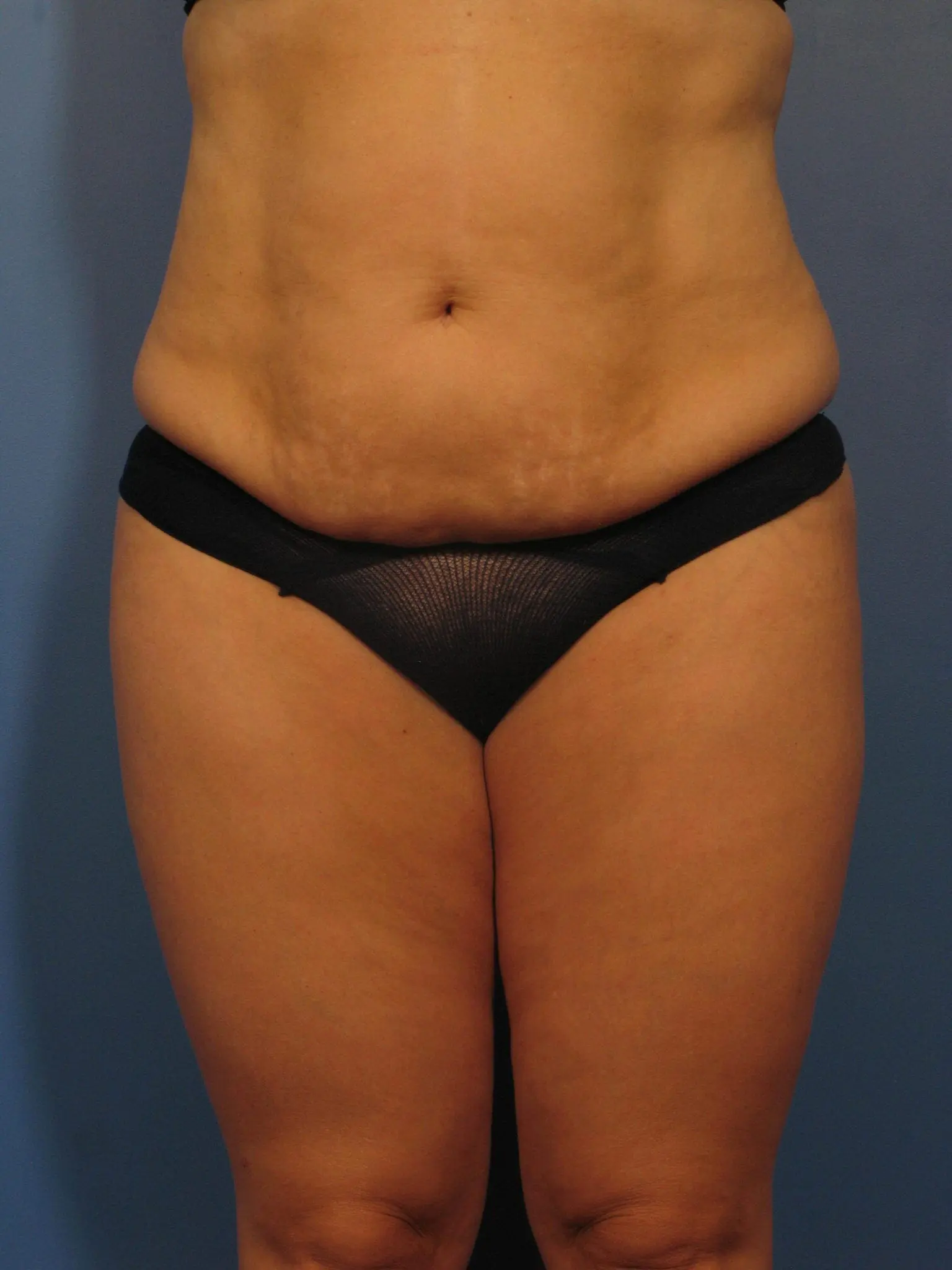 Tummy Tuck Patient Photo - Case 359 - before view-