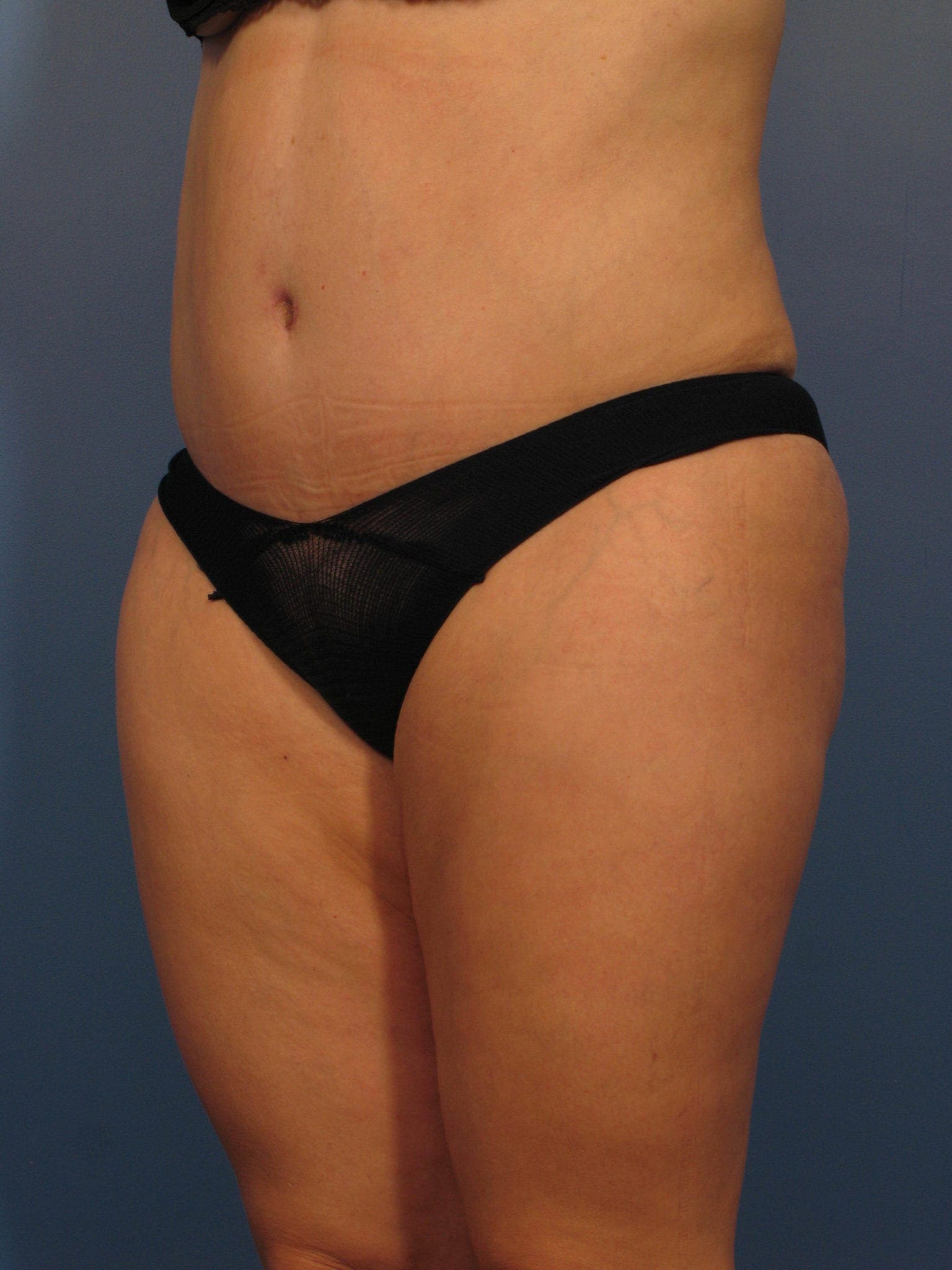 Tummy Tuck Patient Photo - Case 359 - after view-1