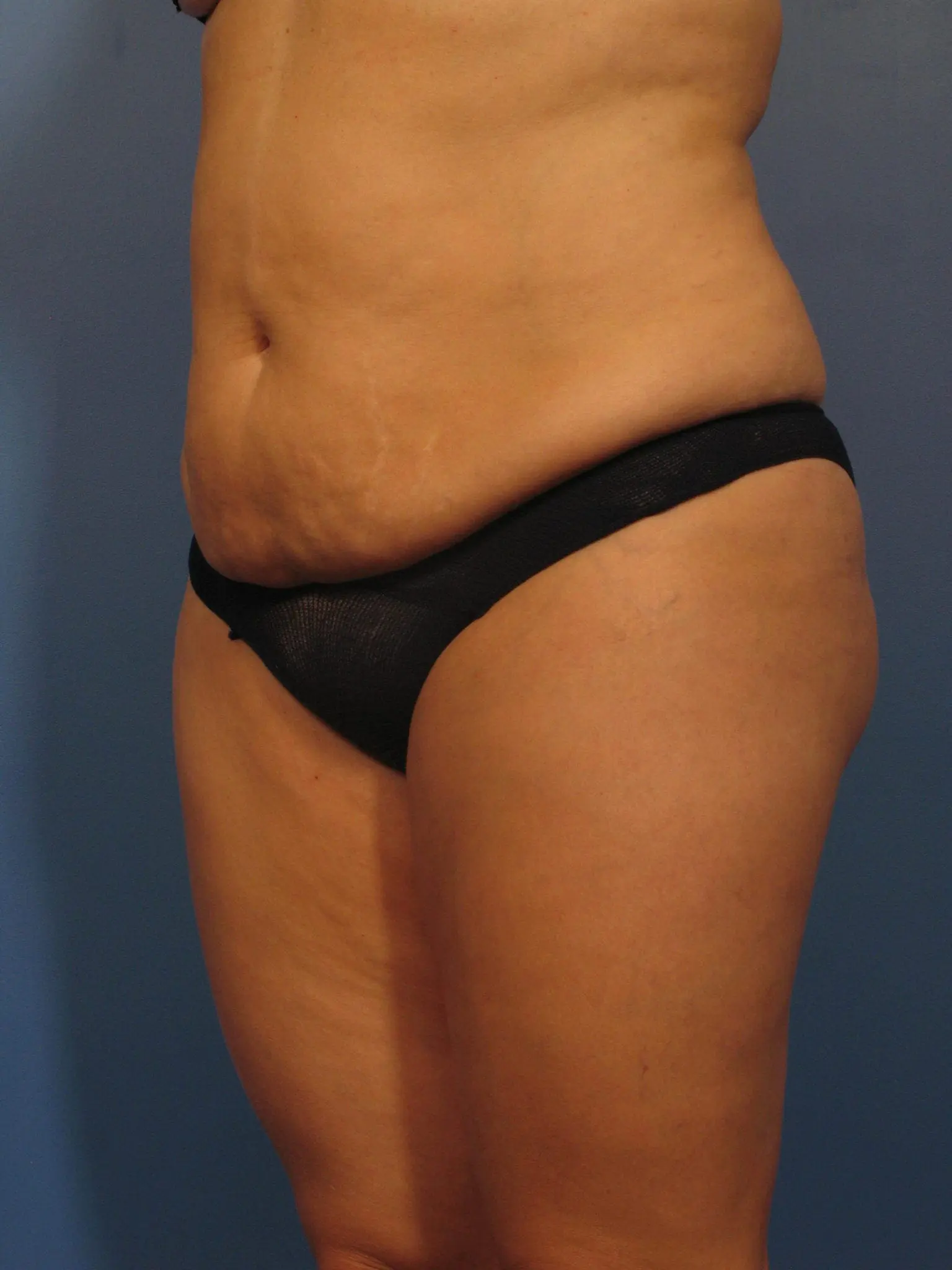 Liposuction Patient Photo - Case 359 - before view-2