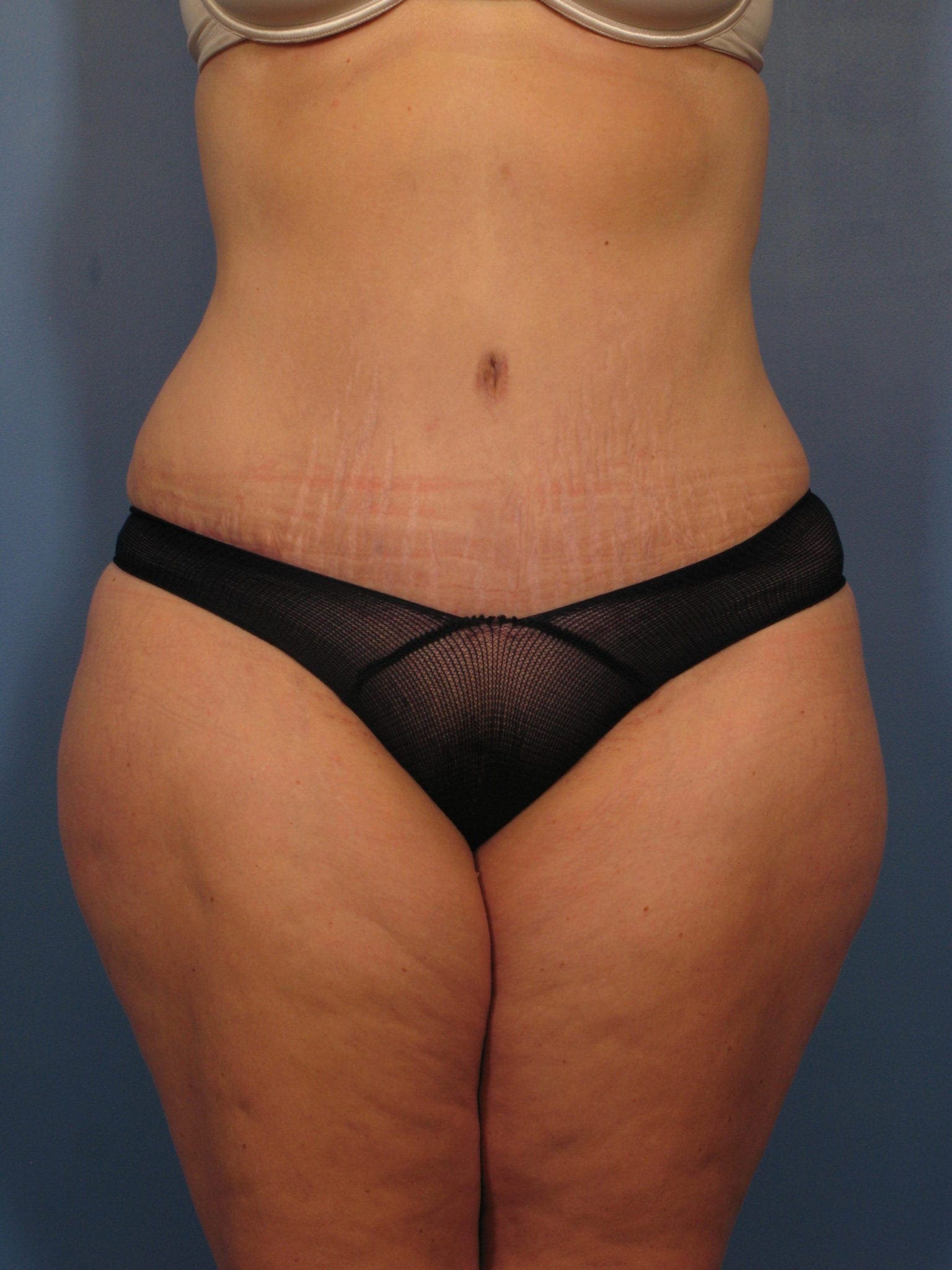 Tummy Tuck - Case 362 - After