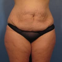 Tummy Tuck - Case 362 - Before