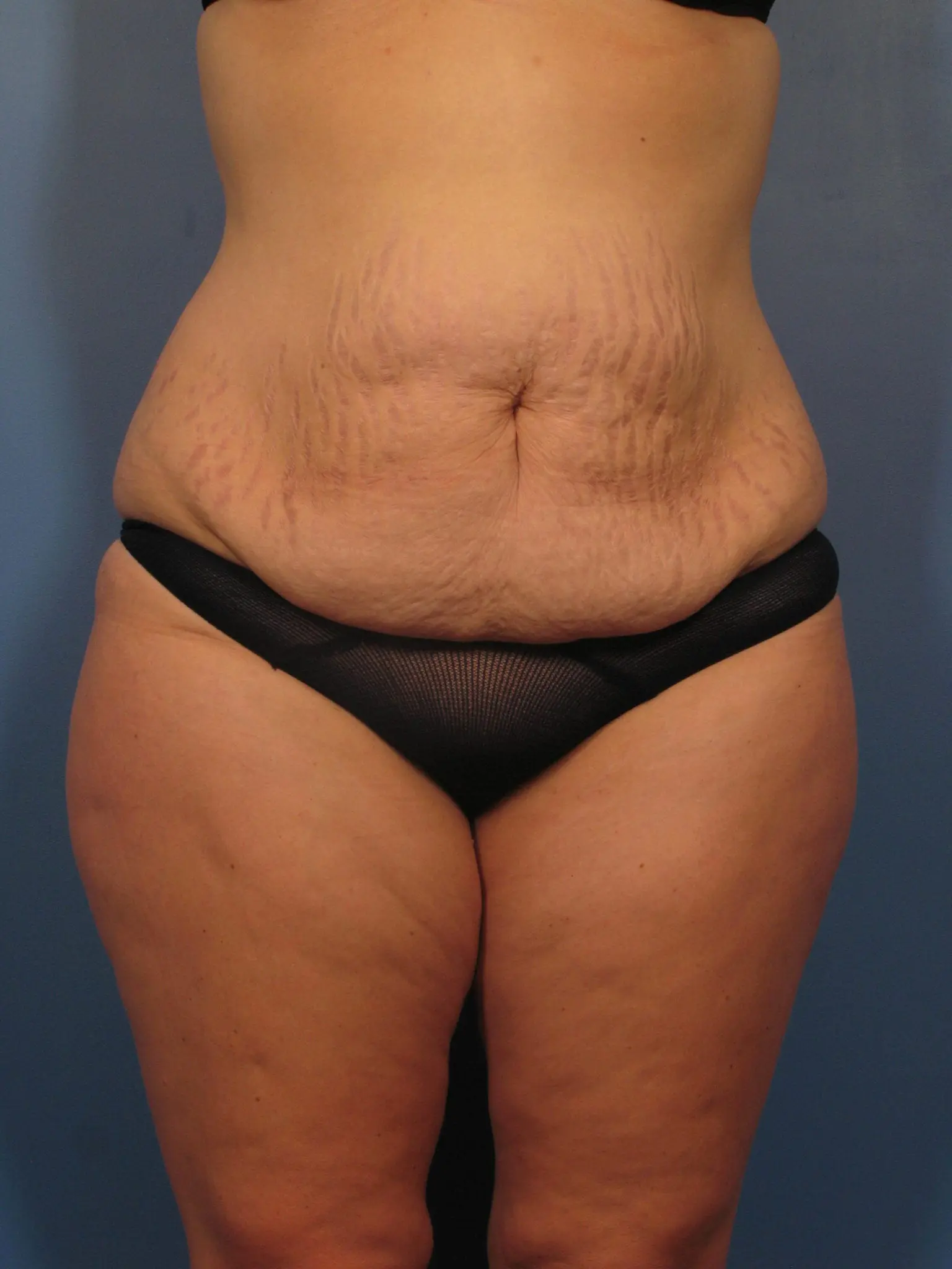 Tummy Tuck Patient Photo - Case 362 - before view-