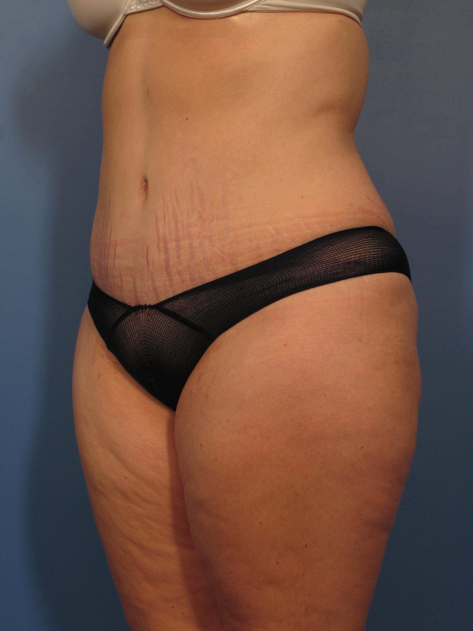 Tummy Tuck Patient Photo - Case 362 - after view-1