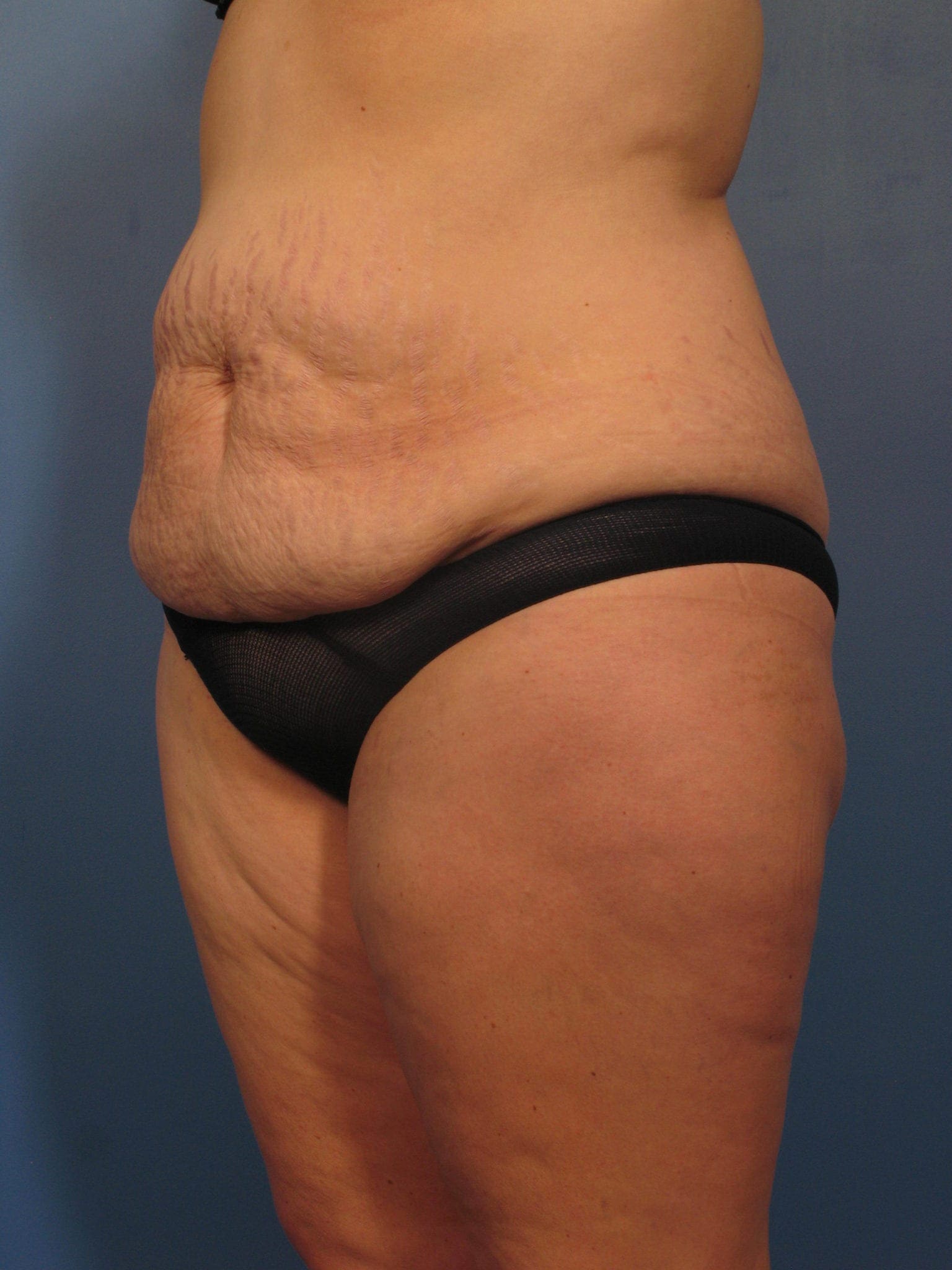Tummy Tuck Patient Photo - Case 362 - before view-1