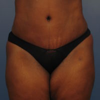 Tummy Tuck - Case 363 - After