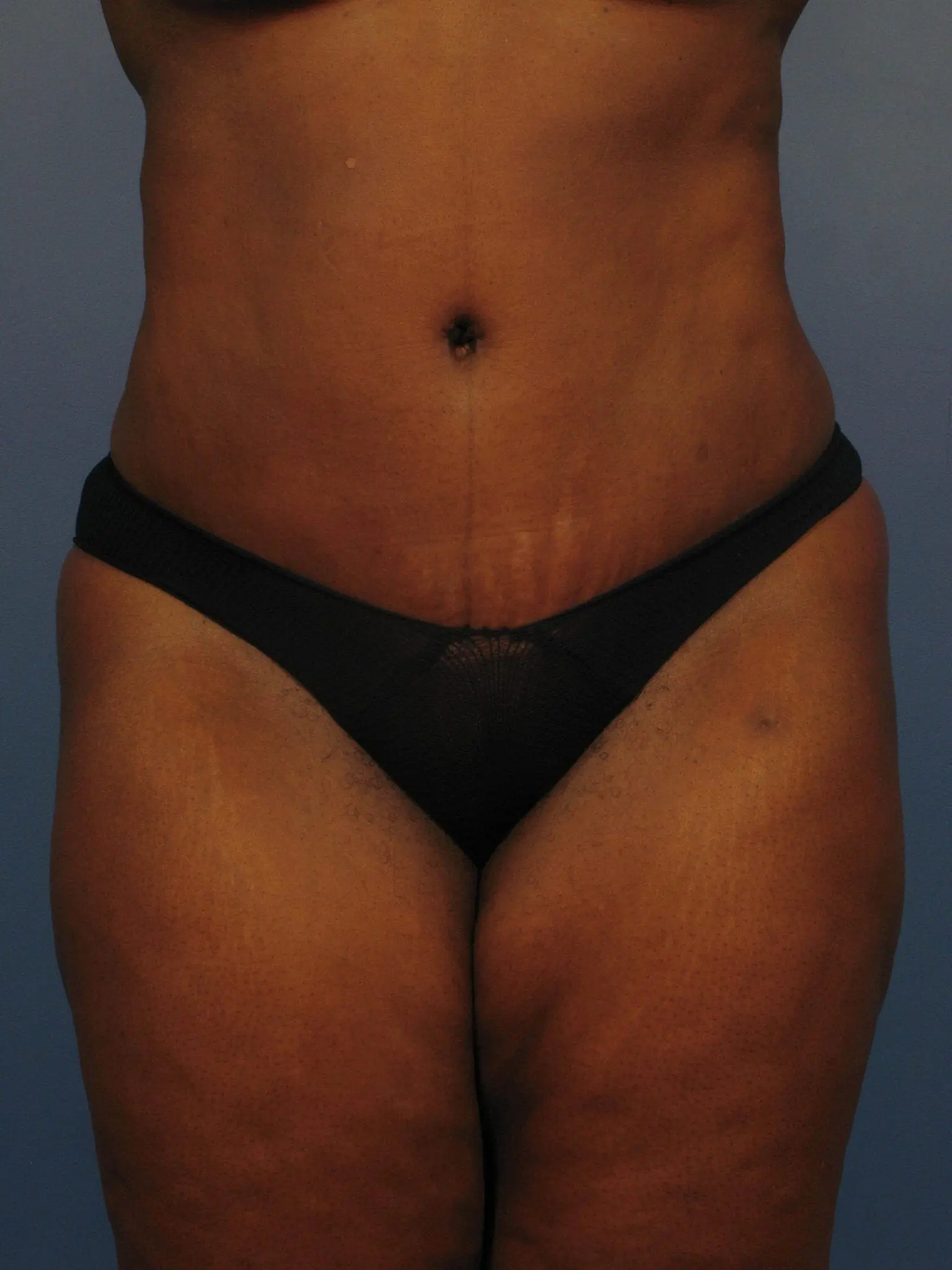 African American Tummy Tuck