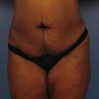 Tummy Tuck - Case 363 - Before