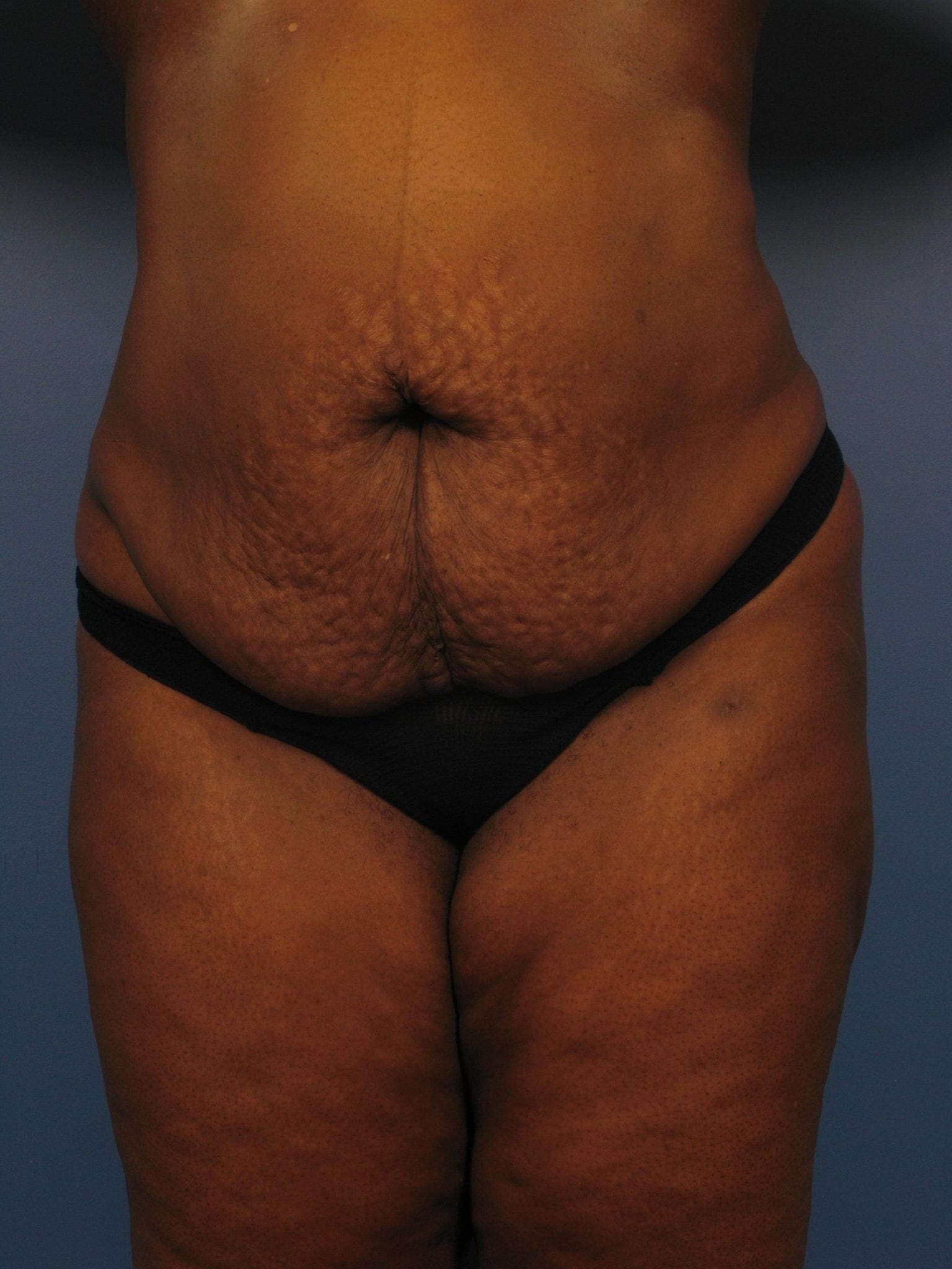 Tummy Tuck Patient Photo - Case 363 - before view-