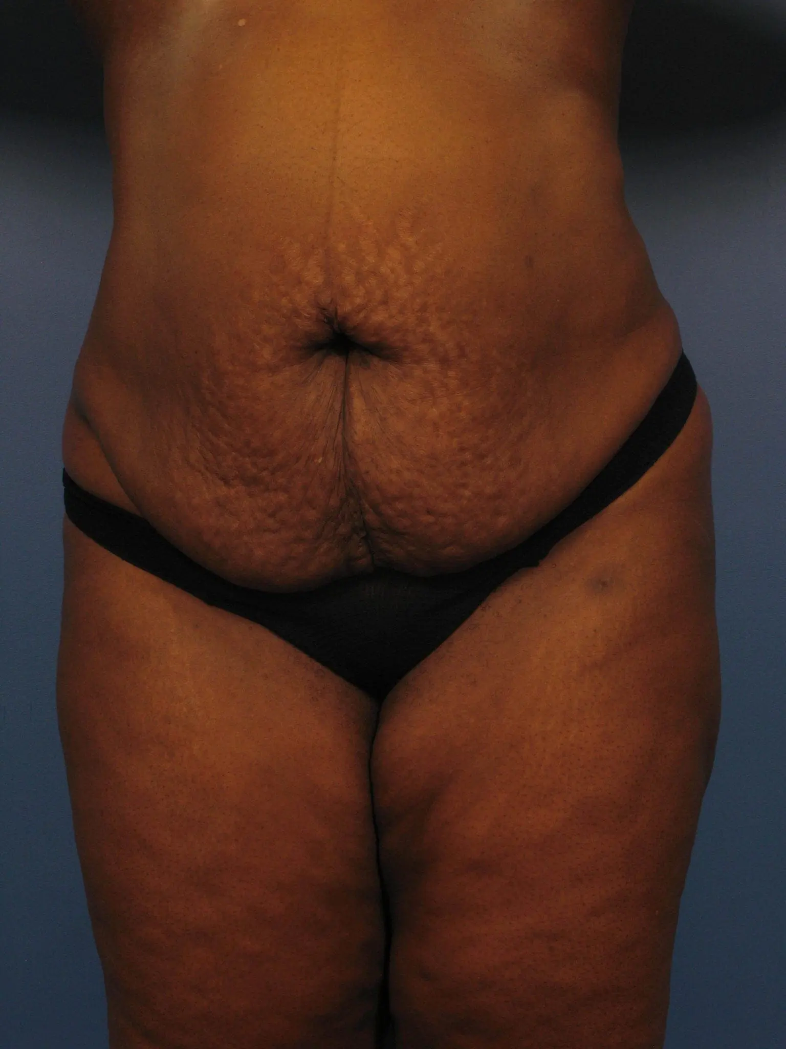 Tummy Tuck Patient Photo - Case 363 - before view-