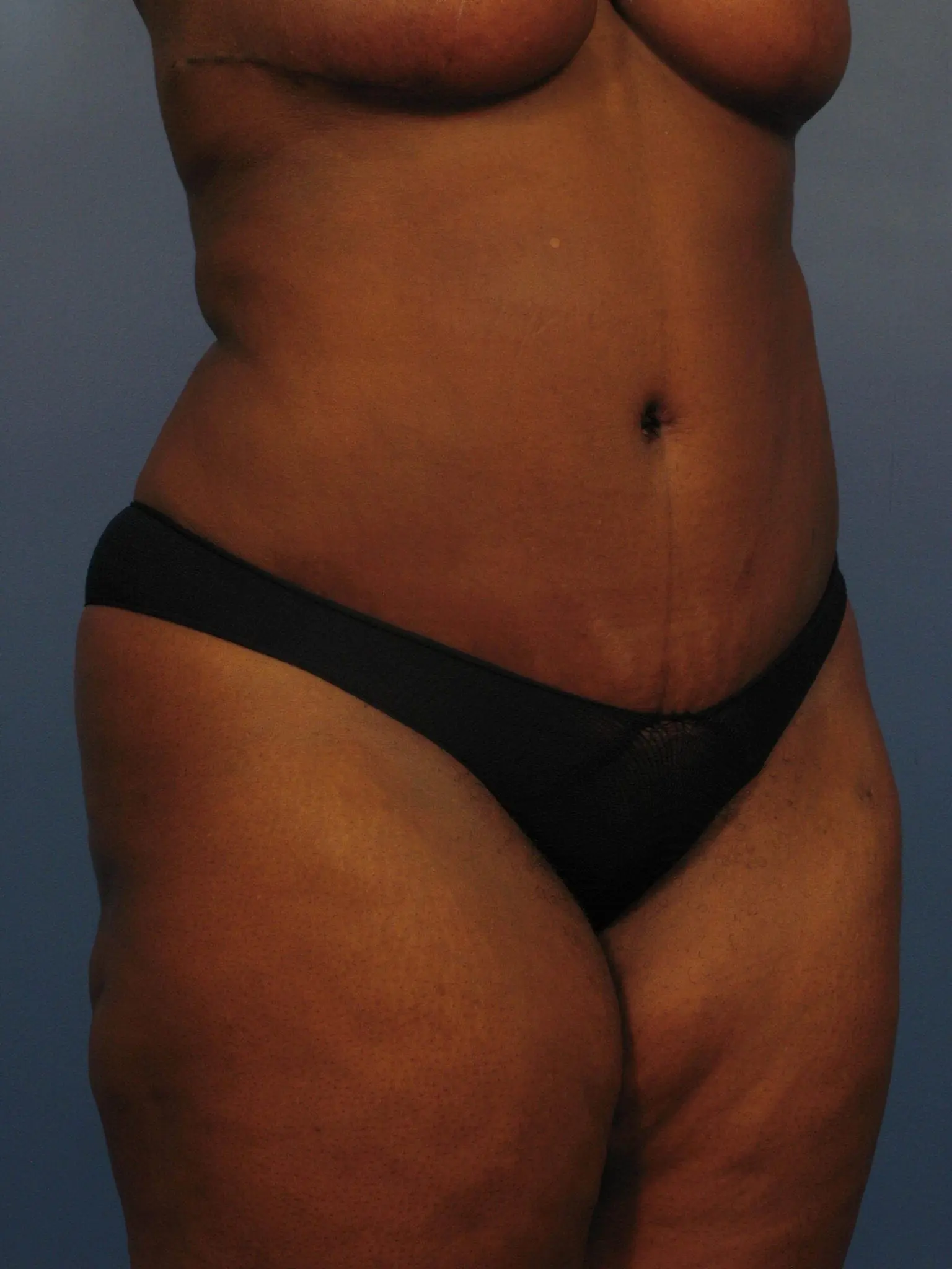 Tummy Tuck Patient Photo - Case 363 - after view-1