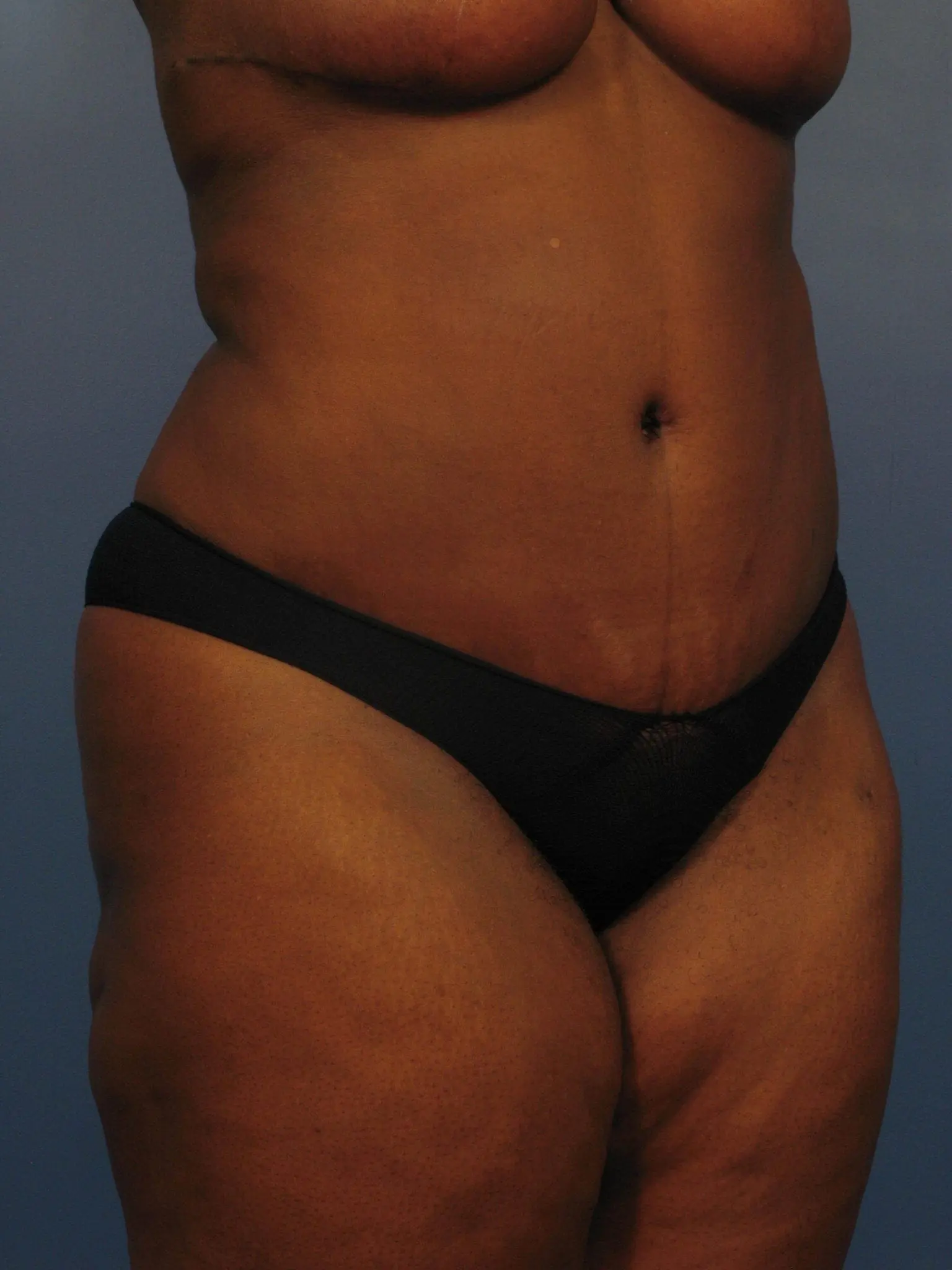 Case 363 Tummy Tuck Before and After Photos