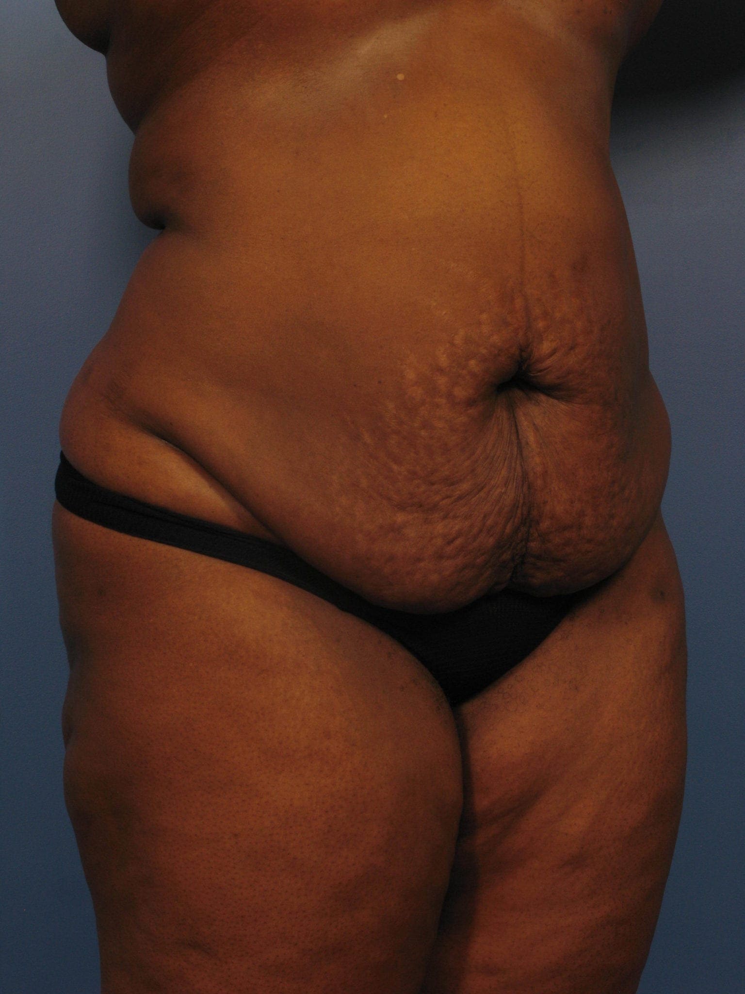 Tummy Tuck Patient Photo - Case 363 - before view-1