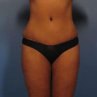 Liposuction - Case 364 - After